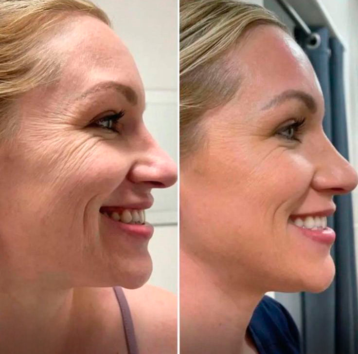 Resultados de antes e depois