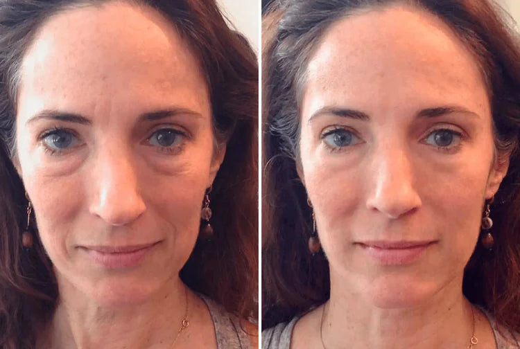 Resultados de antes e depois