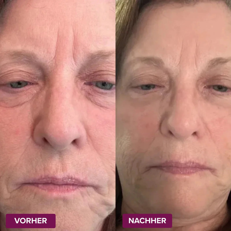 Resultados de antes e depois